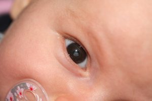 grauer star baby kontaktlinsen